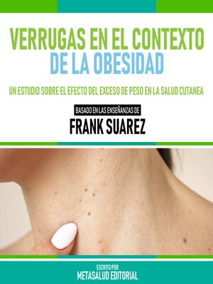 cover image of Verrugas En El Contexto De La Obesidad--Basado En Las Enseñanzas De Frank Suarez